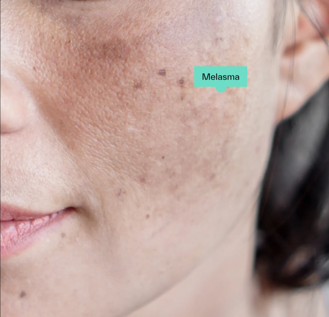 Melasma: What It Is, Why It Happens, and How to Treat It Gently