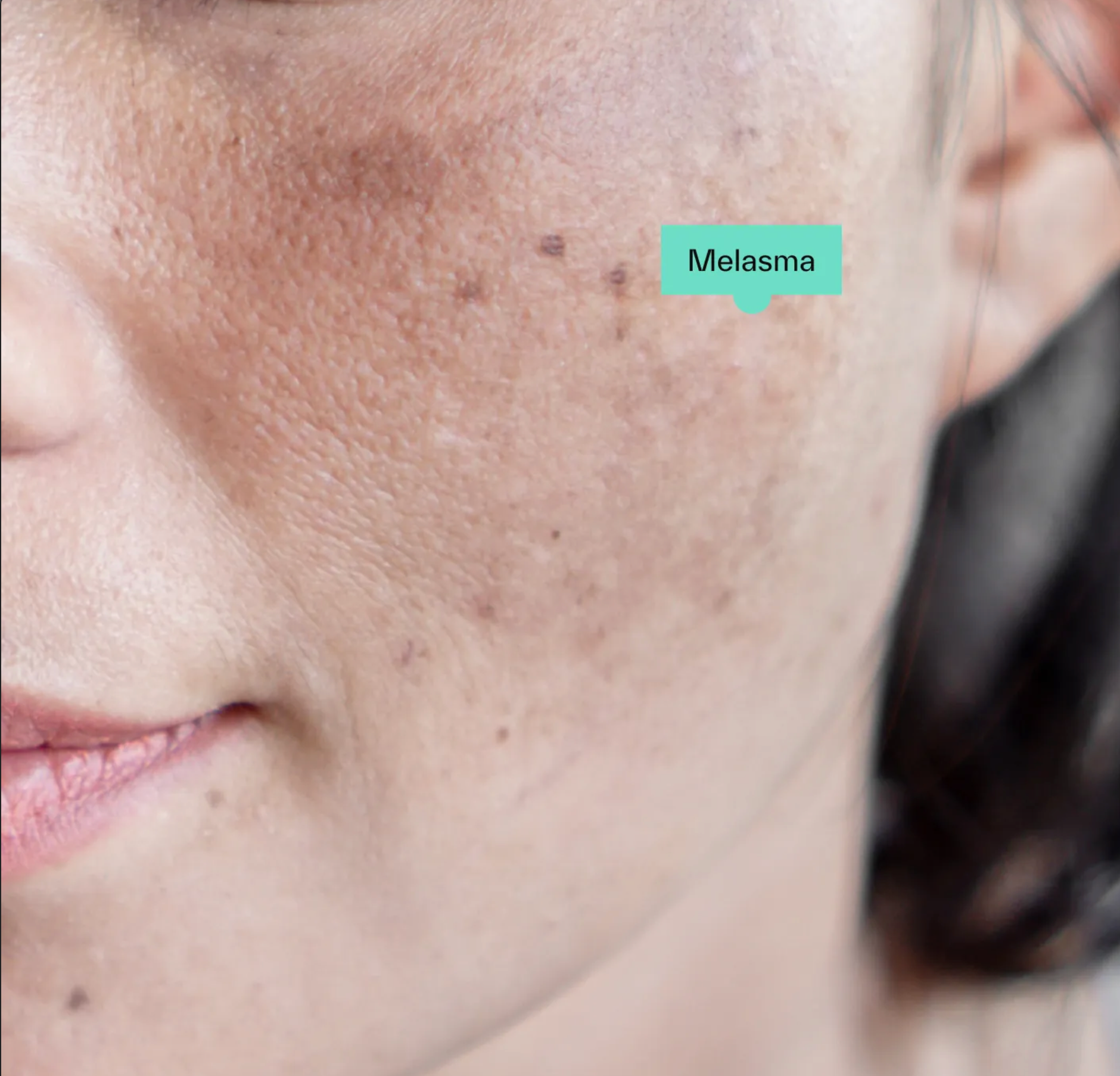 Melasma: What It Is, Why It Happens, and How to Treat It Gently