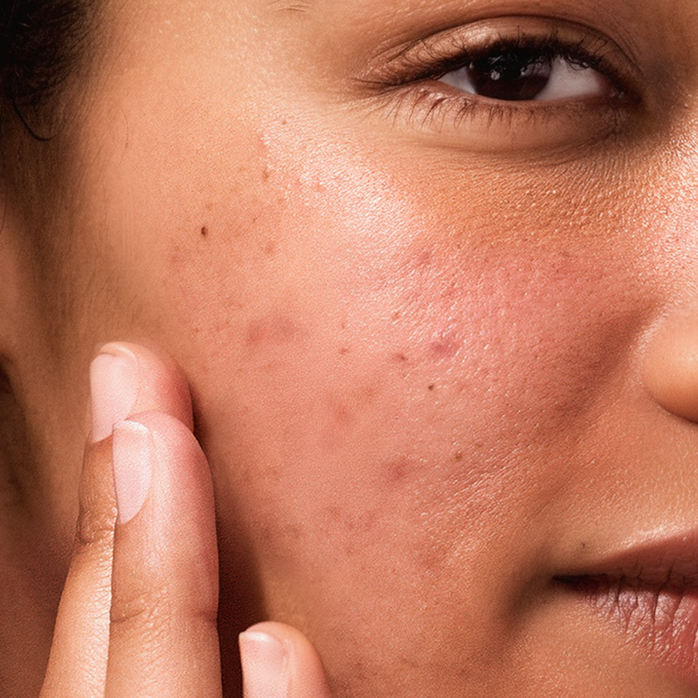Melasma: What It Is, Why It Happens, and How to Treat It Gently