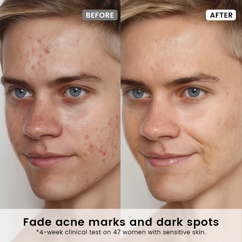 Acne Marks Repair Duo