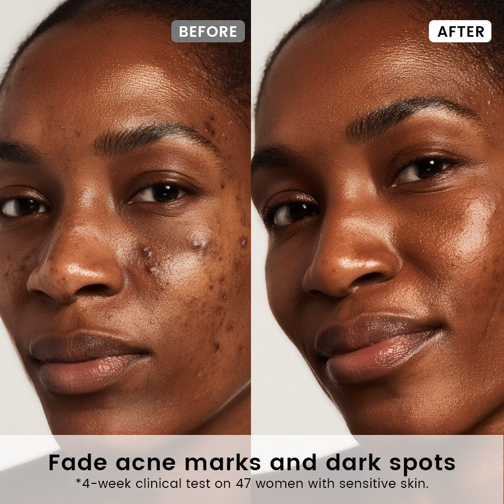 Acne Marks Repair Duo