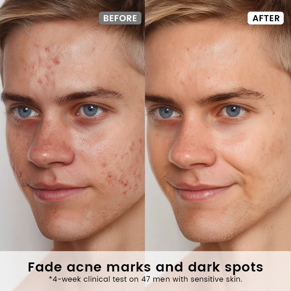 Acne Marks Repair Duo