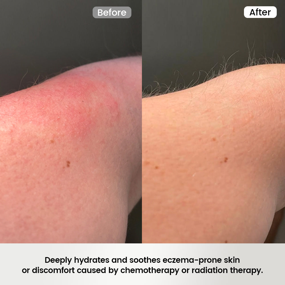 Alra_Therapy_Lotion_deeply_hydrates_and_soothes_eczema-prone_skin_and_skin_affected_by_chemotherapy_or_radiation_therapy.