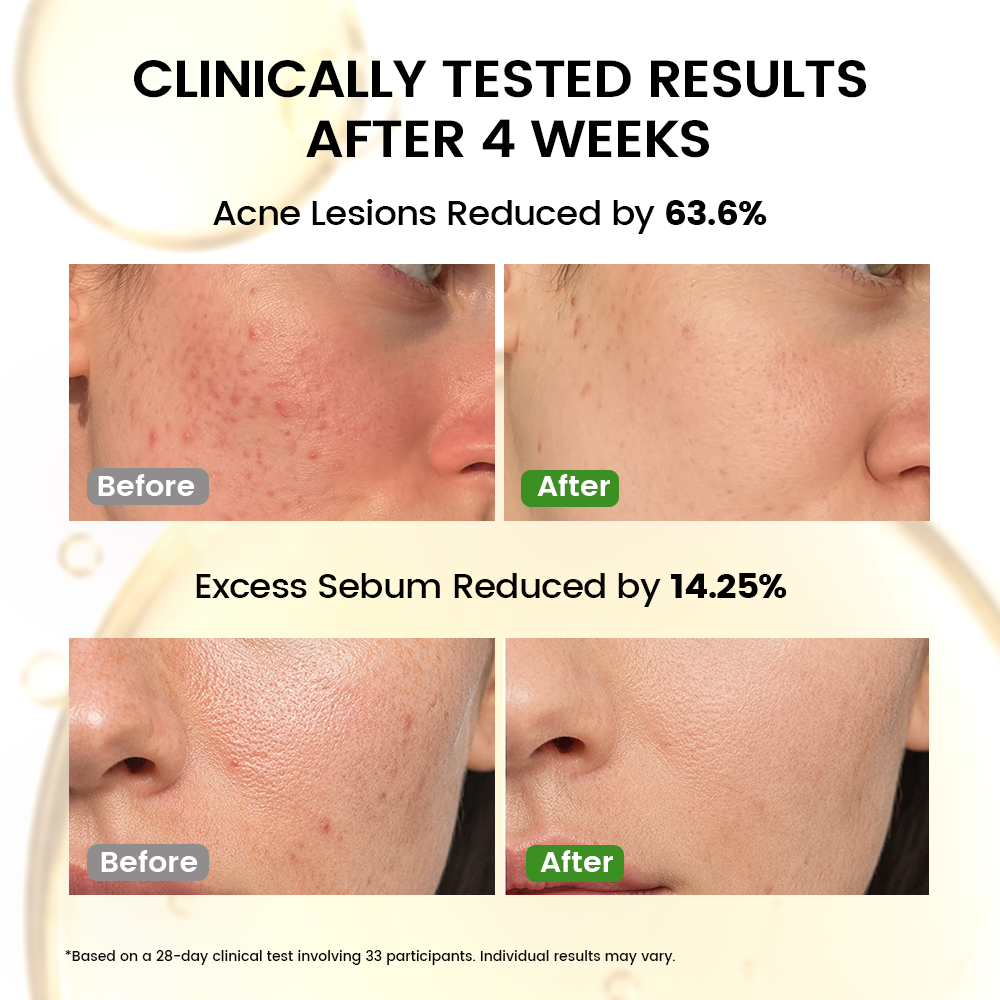 Alra Olive Therapy Serum | Antioxidant Serum for Sensitive & Acne-Prone Skin