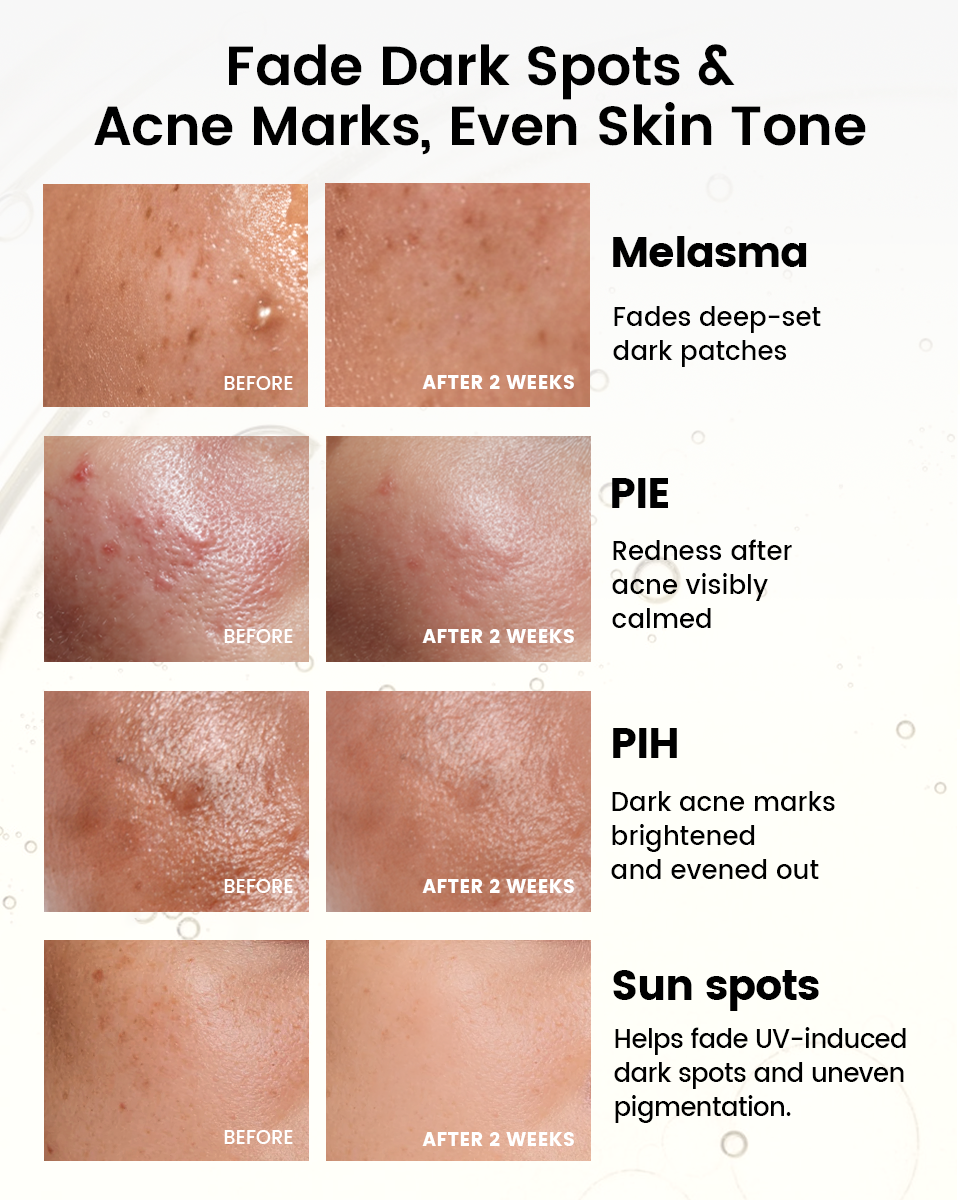 Alra dark spot correcting serum to help fade dark spots, acne marks, and even skin tone